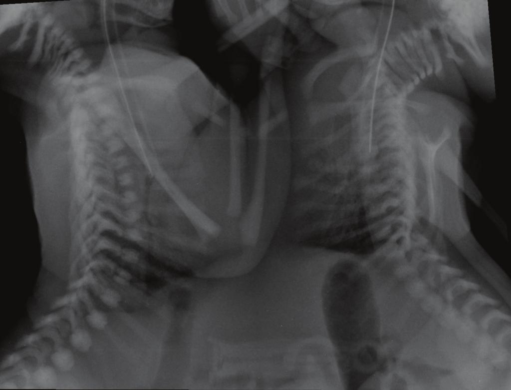 2 Case Reports in Radiology Face to face Fused from the lower chest to the upper abdomen in the ventral aspect Twin A is on the left lateral position, while twin B is on the right lateral position of
