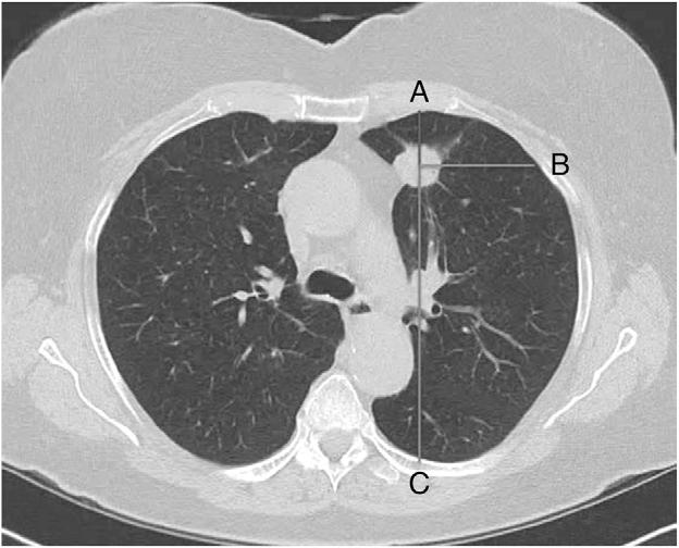 Results Baseline Characteristics Eighty-five pulmonary lesions were identified in 46 patients, providing 46 INSP-EXP datasets.