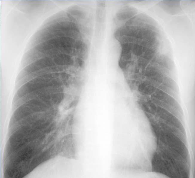 Case 3: TB or Not TB? 30 yo woman, moved to US from India 4 yrs ago Needs clearance to work in school TST 12 mm No symptoms What would you do next?