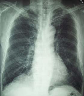 Case 2: Patient B 76 yo male from China (in US since 1979) Cough