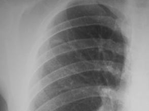 Case 1: TB or Not TB?