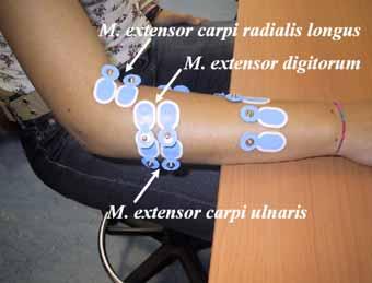 The Friction Force Mouse-Pad and the Forearm Muscles Efforts The Ergonomics Open Journal, 2010, Volume 3 7 and abduct/radial deviation hand at wrist joint) (Fig. 4). Results in the M.