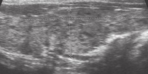Virmani and Hammond Fig. 4 26-year-old woman with papillary carcinoma on background of Hashimoto thyroiditis., Ultrasound scan shows giraffe pattern that is typical for Hashimoto thyroiditis.