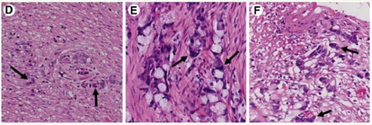 Hum Pathol 2015; 46:1881-9 Recognition of Adenocarcinoma in GCC Peritumoral stromal desmoplasia that replaces the smooth muscle of the appendiceal wall Lee LH, et al.