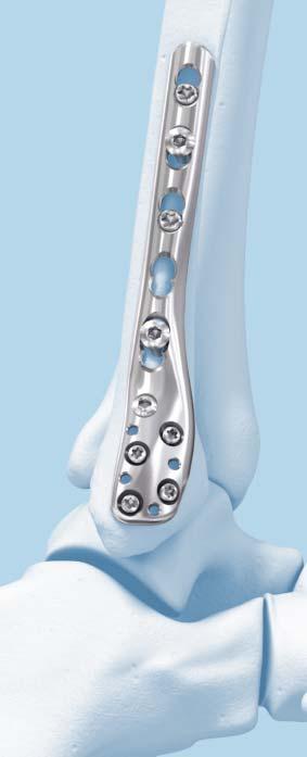 2.7 mm/3.5 mm LCP Distal Fibula Plate System. Part of the locking compression plate (LCP) system.