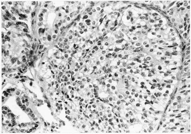 Mammary Hyperplasia in Monkeys 133 Fig. 3. Part of mammary nodule with acinar epithelial hyperplasia containing cells with vaciiolated cytoplasm. HE.