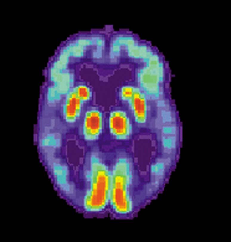 . PET scan of the brain of a person with AD