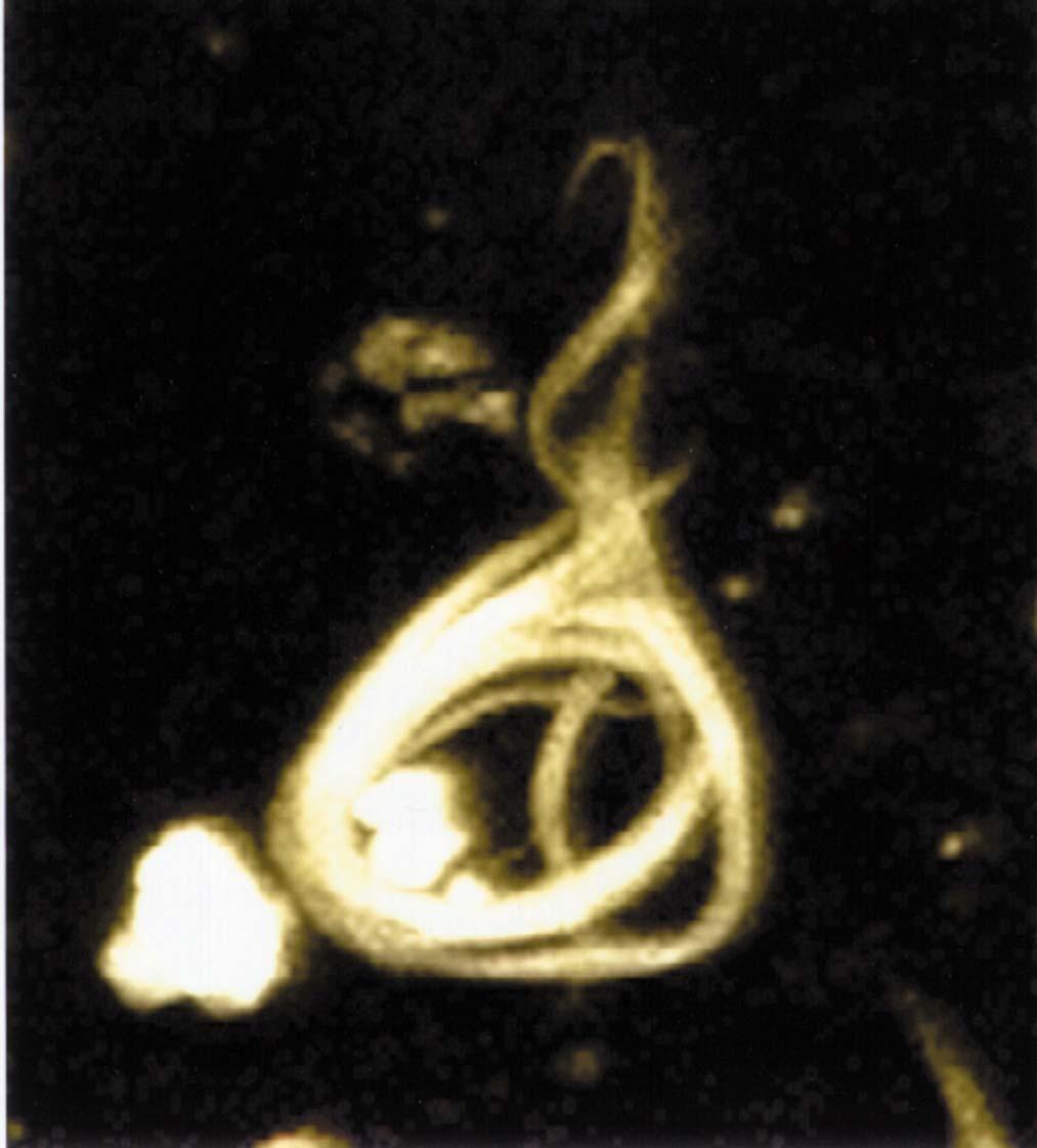 Microscopy image of a neurofibrillary tangle,