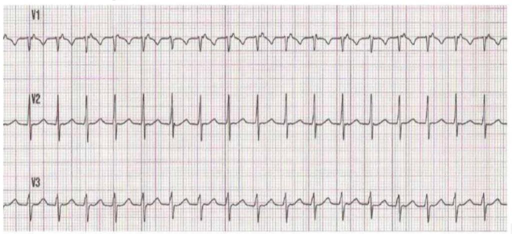 9.- Rhythm strip recorded before the interruption of narrow QRS complex tachycardia by carotid sinus massage and apnea maneuvers. The most likely mechanism is : a.