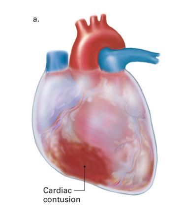 Specific Chest Injuries Cardiac Contusion Cardiac Contusion Cause Signs and