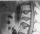 Modern Stone Age Equivalent: Case 1 67-year-old white woman with a history of two recent, minimal trauma, painful grade-2 vertebral fractures at T10 and T11 by vertebral fracture assessment (VFA).