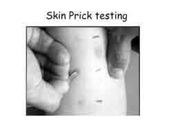 Skin Test Less expensive Greater sensitivity Wide allergen selection Results available immediately FIRST CHOICE TESTING RAST No patient risk Patient-doctor