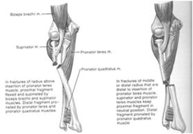 Factors Radial head most important and provides 30% of valgus stability Posterior