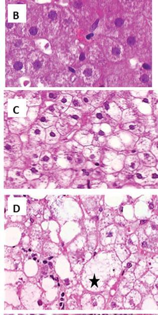 Ballooning and lobular inflammation grading. B) Normal hepatocytes, ballooning, grade 0. Cytoplasm is pink and granular and liver cells have sharp angles. H&E, X 40. (C) Ballooning, grade 1.