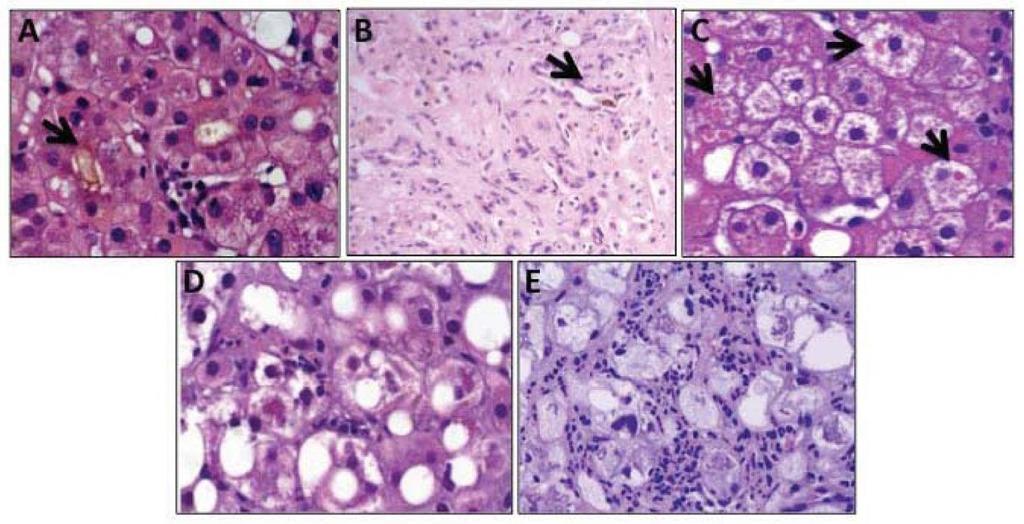 Histological Features Independently Associated with 90-day survival: A) Hepatocellular and canalicular