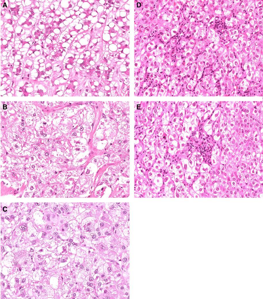 Steatotic hepatocellular carcinoma: a variant associated with metabolic factors and late tumour relapse