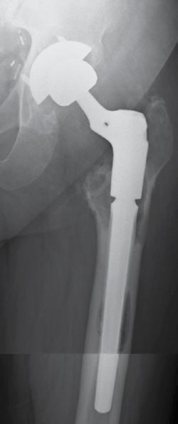 Modular Femoral Tapered Revision Stems in Total Hip Arthroplasty 37 Figure 2. A 65-year-old male patient with BMI of 38.