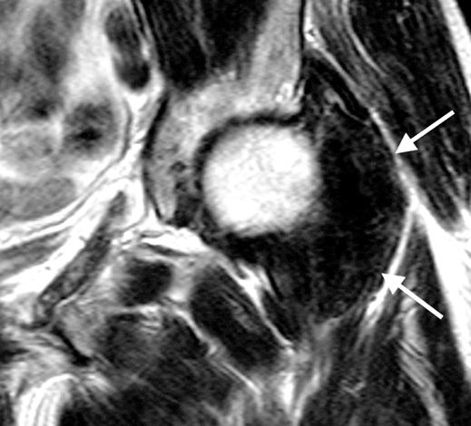 B, Coronal T1-weighted MR image (TR/TE, 500/14) reconfirms erosion (arrowhead), which is much more obvious than in conventional radiograph.