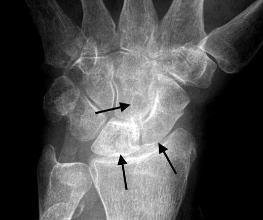 Kiss et al. is not diagnostic, imaging findings combined with history and clinical findings are usually used for assessment of musculoskeletal involvement by dialysis-related amyloidosis.