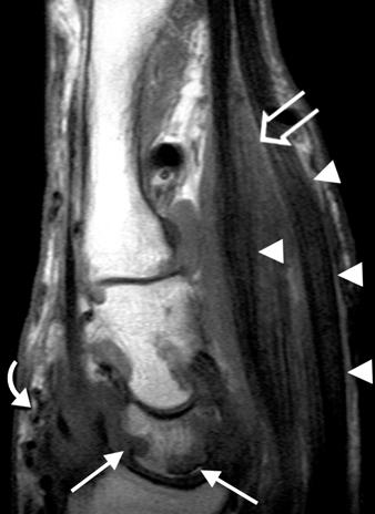 A, Conventional radiograph shows radiolucent lesions of various sizes involving carpal bones (arrows). Most have sclerotic margins and some have a lobulated outline.
