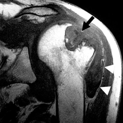 D, Coronal T1-weighted MR image (470/12) shows osteolysis in superior posterior humeral head, which communicates with joint (arrow).