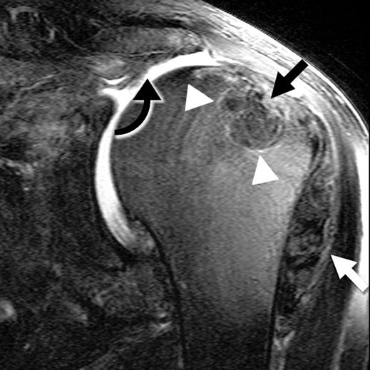Amyloid deposits are also visible within subdeltoid bursa between deltoid muscle and humerus (arrowheads).