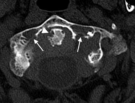 Erosion in anterior aspect of odontoid process (white arrowhead) is also present.