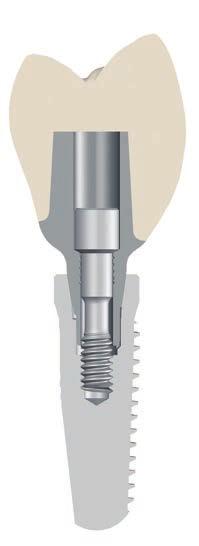 The CONELOG Abutments are apical with a cone and three cams, and lock into the conical connection and the three grooves of the implant.