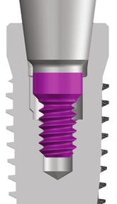 These abutments are screwed into the CONELOG Implant using the corresponding drivers at a defined torque.
