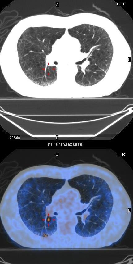 Lung tumor