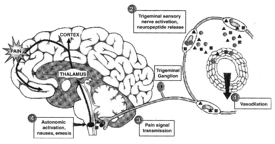 The Trigeminovascular Theory Adapted from Lancet 1998;351:1045 ABORTIVE TREATMENT OF MIGRAINE Selective 5-HT 1B/1D, receptor agonists ( Triptans