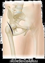 Anterior Approach Not as popular as Posterior Approach, but is gaining popularity among surgeons Incision Caution not to damage the lateral femoral cutaneous nerve near the anterior iliac spine