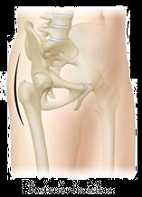Posterior Approach 70% of orthopedic surgeons use this approach Incision Muscles that are split or detached: Iliotibial Band Gluteus Maximus Sometimes gluteus maximus