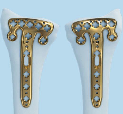 Preparation Select implant Select the plate according to the fracture pattern and anatomy of the bone.