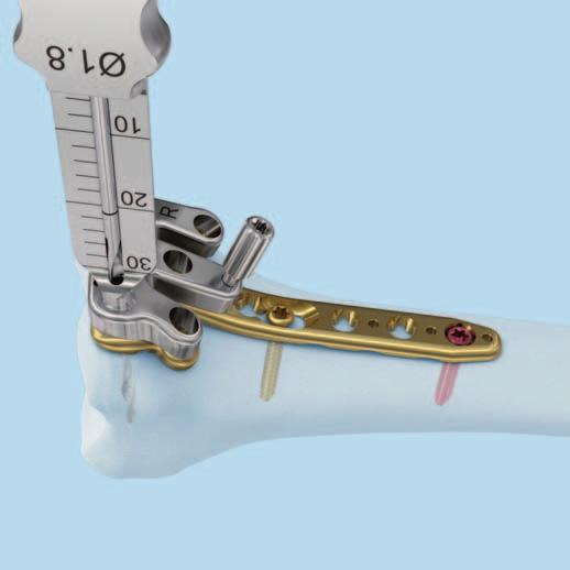 Drill using guiding blocks Alternatively, use the volar rim distal radius plate guiding block in combination with the quick drill sleeve.