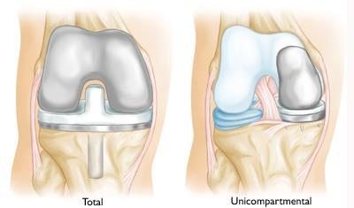hemiarthroplasty Done in the medial or lateral compartment of the