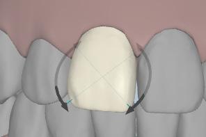 STEP 4: CHANGING TOOTH POSITION Click and drag movement axis with mouse to reposition tooth