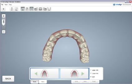 STEP 4: ADJUST ARCH FORM Constrict Arch