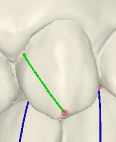 : ADJUST INCORRECT AXIS LINES Click on incisal or gingival dot and drag to