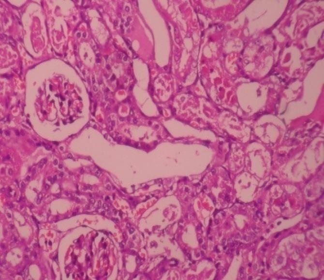 In group II (gentamicin treated) rats various degrees of focal lesions in many sections including tubular congestion, tubular desquamation and hyaline casts have been seen.
