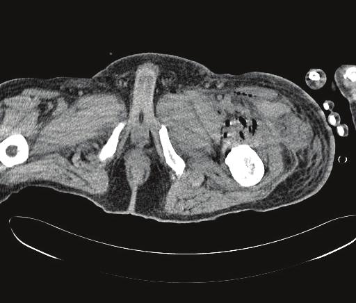In one review of thigh abscesses secondary to abdominal infections, the majority of these abscesses were located in the anterior and medial aspects of the thigh, indicating spread via the psoas and