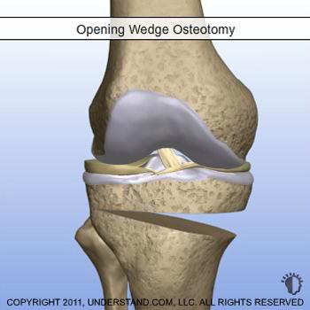 Procedure Variations Osteotomy procedures can be done to correct either a bowlegged (varus deformity) or knock-kneed (valgus deformity) malalignment.