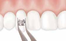 Adhesive Primer 9 Prime tooth 10 Prime bracket