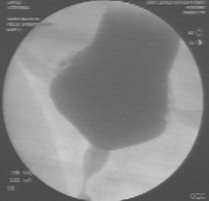 Urodynamic tracing. In this patient there is an apparent increase in sphincter activity at the beginning of voiding.