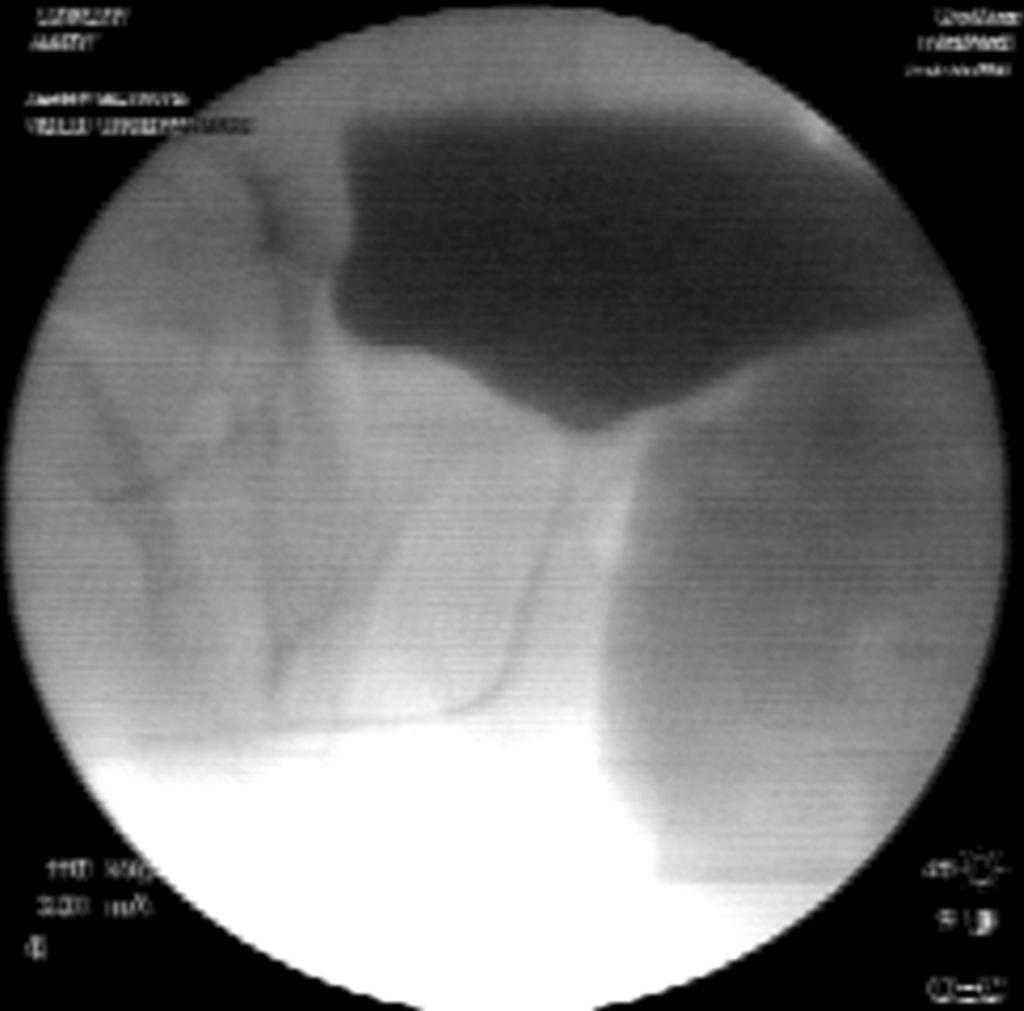 (D) X-ray obtained at Qmax shows a urethra of