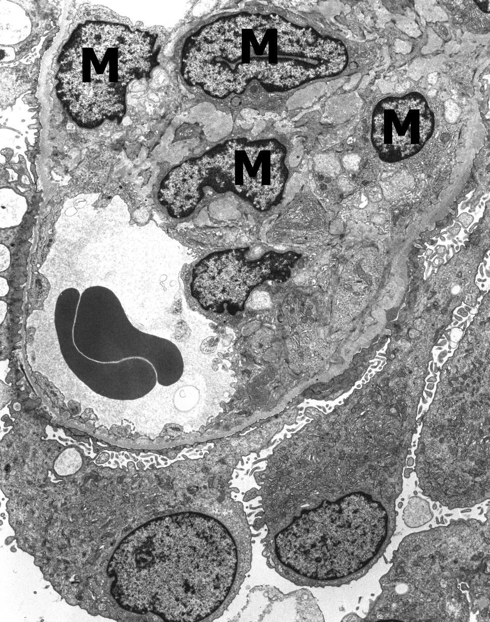 Mesangial Hypercelluarity The glomerular mesangium contains increased matrix and four nuclei (M).