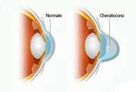 these disorders, the cornea is weakened and therefore tends to be progressively deformed under pressure within the eye.