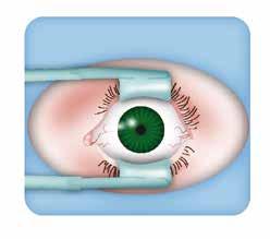 miotic eye drops (to