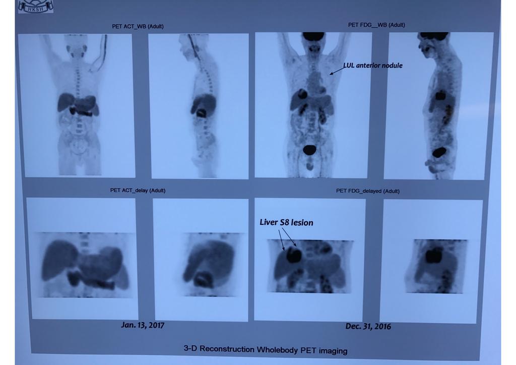 PET-CT scan-jan 2017 Large hypodense at segment 8 (SUV11.