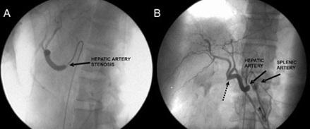 Slika 1. Slika 1a. Nedostaje celijačni trunkus, zajednička hepatična i lijenalna arterija se samostalno odvajaju od aorte. A Stenoza ostijuma hepatične arterije 90%. Profilna selektivna angiografija.